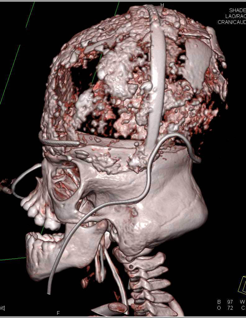 Cranial Deformity with Unusual Facial Features - CTisus CT Scan