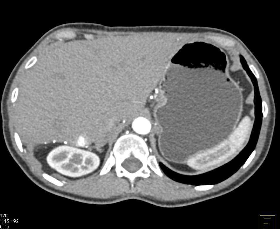 Clot in Superior Mesenteric Vein (SMV) - CTisus CT Scan