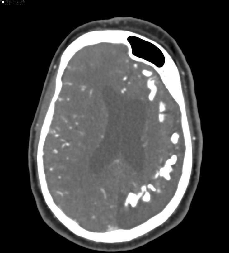 Sturge-Weber Syndrome - CTisus CT Scan