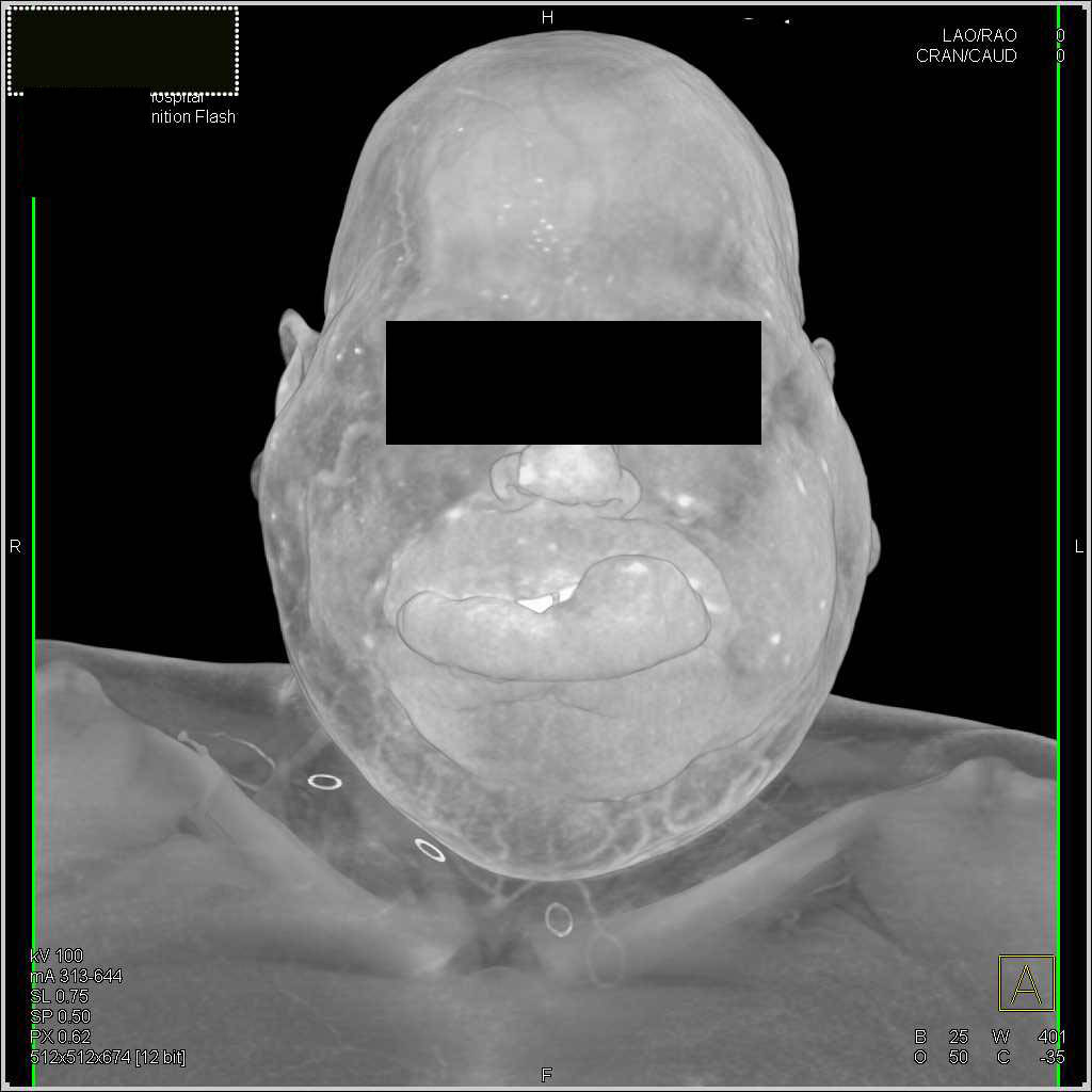 Sturge-Weber Syndrome - CTisus CT Scan