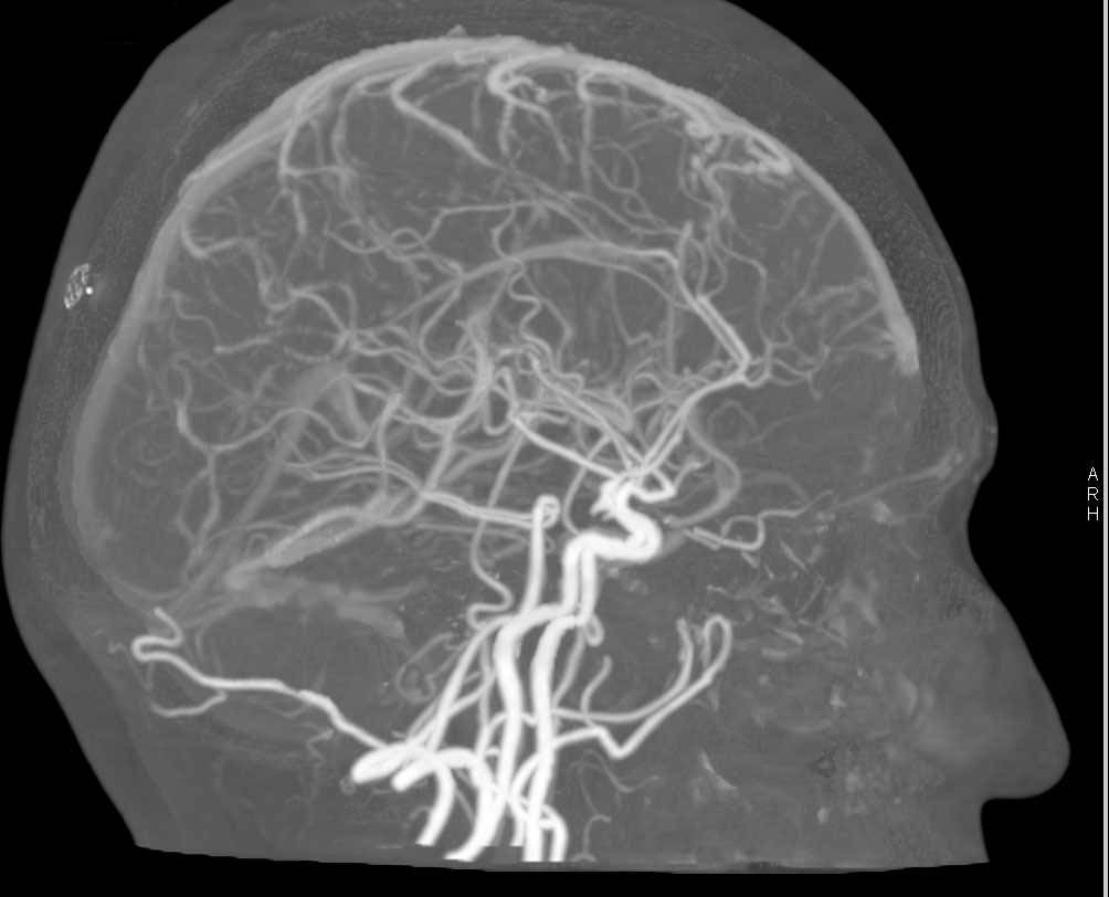 CTA of the Brain with Bone Removal via DE Technique - Neuro Case