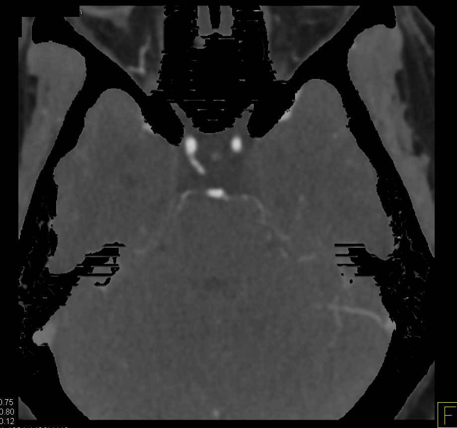 CTA with Normal Circle of Willis - CTisus CT Scan