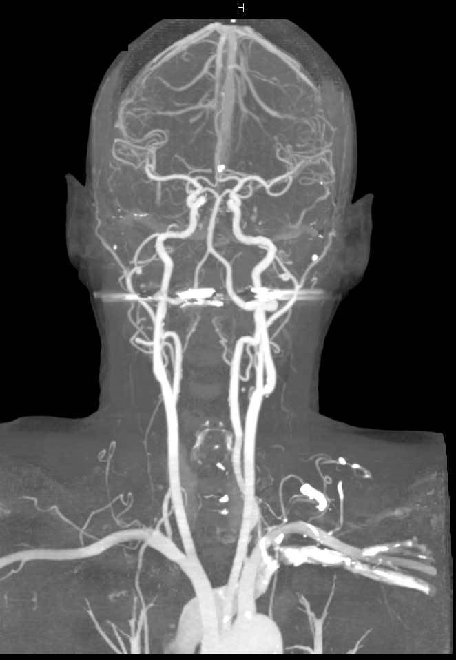 CTA with DE of Carotid Arteries - Neuro Case Studies - CTisus CT Scanning