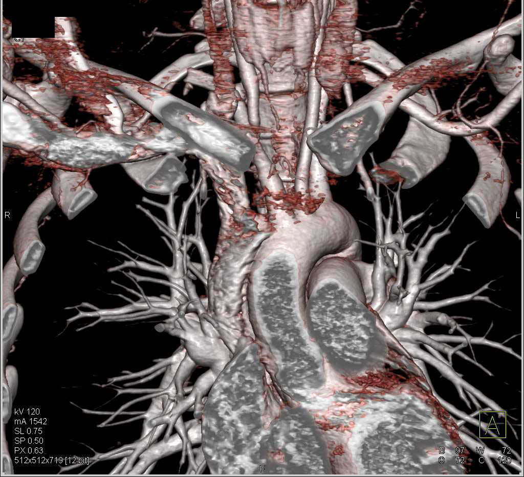 Pseudo Lesion in the Right Carotid Artery - CTisus CT Scan