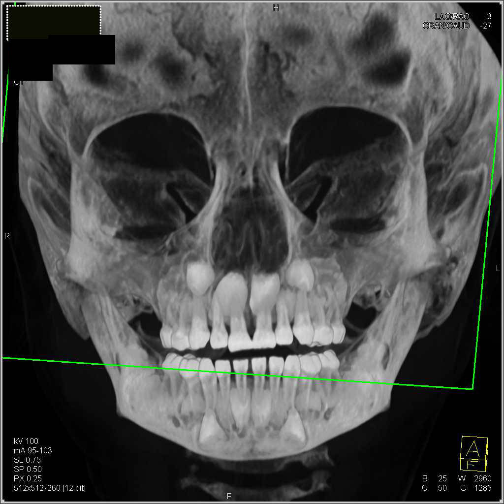 3D of Teeth with Volume Rendering - CTisus CT Scan