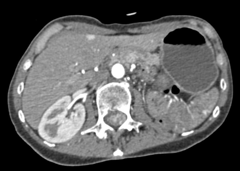 von Hippel Lindau with Right Renal Cell Carcinoma, Left Nephrectomy and Hemangioblastomas to the Spinal Cord - CTisus CT Scan