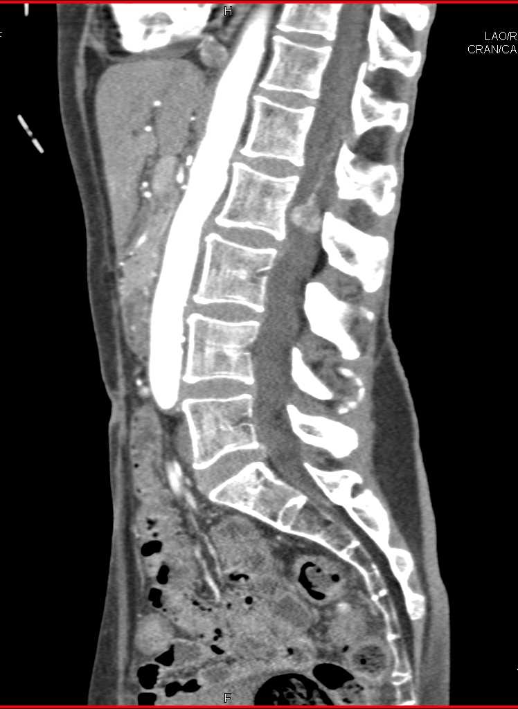 von Hippel Lindau with Right Renal Cell Carcinoma, Left Nephrectomy and Hemangioblastomas to the Spinal Cord - CTisus CT Scan
