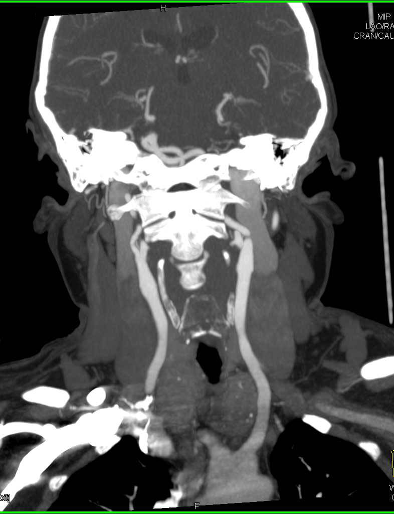 CTA with Multiple Aneurysms Including Circle of Willis - CTisus CT Scan