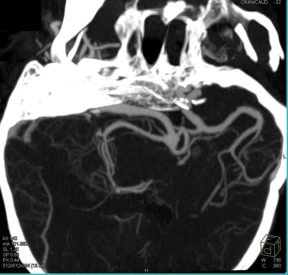 Carotid and Intracranial Artery Aneurysms - CTisus CT Scan