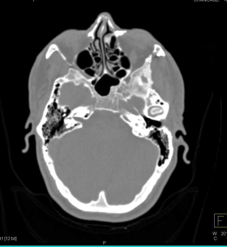 Orbital Fracture with Repair in 3D - CTisus CT Scan