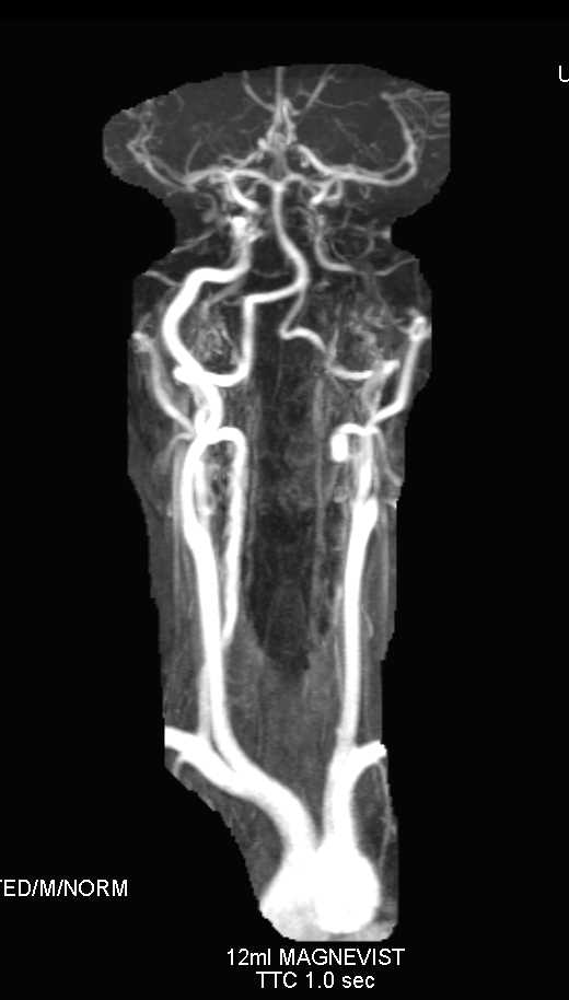 Dual Energy Display of Arch Vessels - CTisus CT Scan