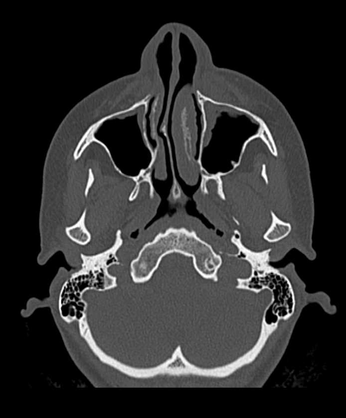 Acute and Chronic Sinusitis - Neuro Case Studies - CTisus CT Scanning