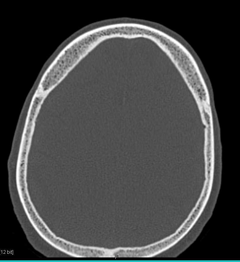 3D of Cranial Vault - CTisus CT Scan