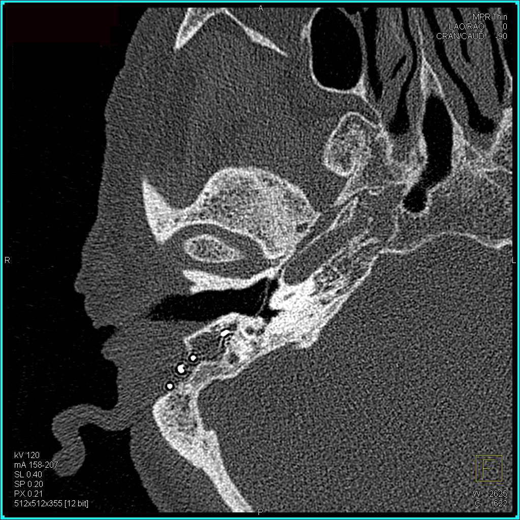 High Resolution Imaging of the Temporal Bone - CTisus CT Scan