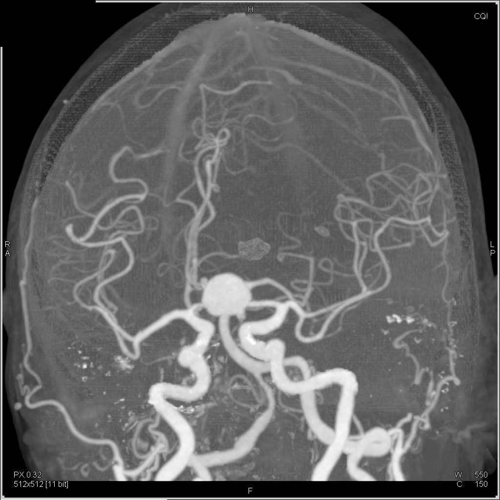 Intracranial Aneurysm in the Circle of Willis - CTisus CT Scan.