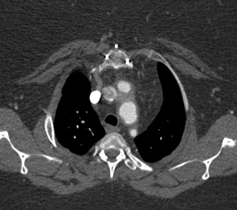 Dilated Left Vertebral Artery - CTisus CT Scan