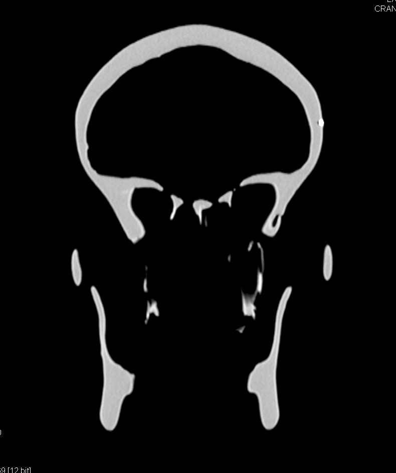 Skull Used to Rehearse Facial Transplant in 3D - CTisus CT Scan