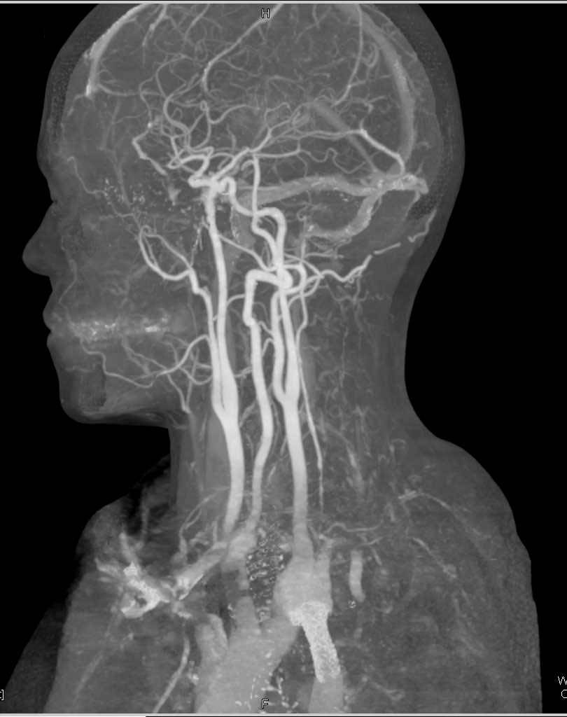 CTA Normal Carotids and Circle of Willis - CTisus CT Scan