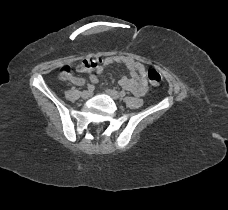 Part of Skull Placed in Subcutaneous Fat of Abdominal Wall to be Used Later - CTisus CT Scan