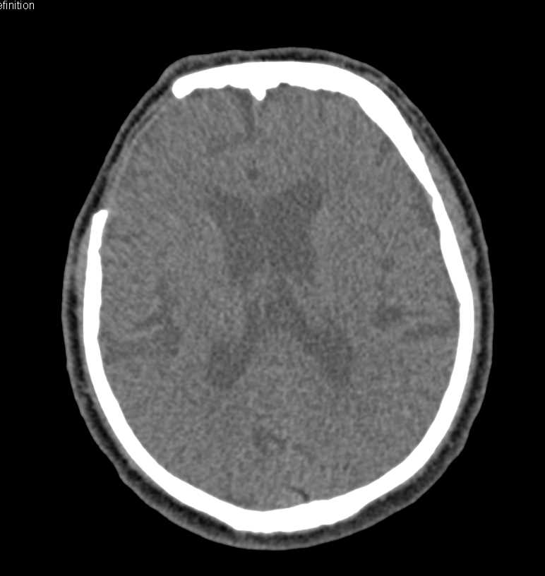 Post Craniotomy Changes in 3D - CTisus CT Scan