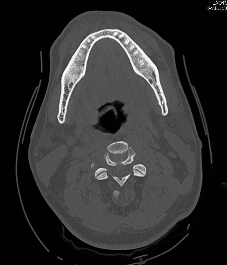 3D of Skull and Spine Post Trauma - Neuro Case Studies - CTisus CT Scanning