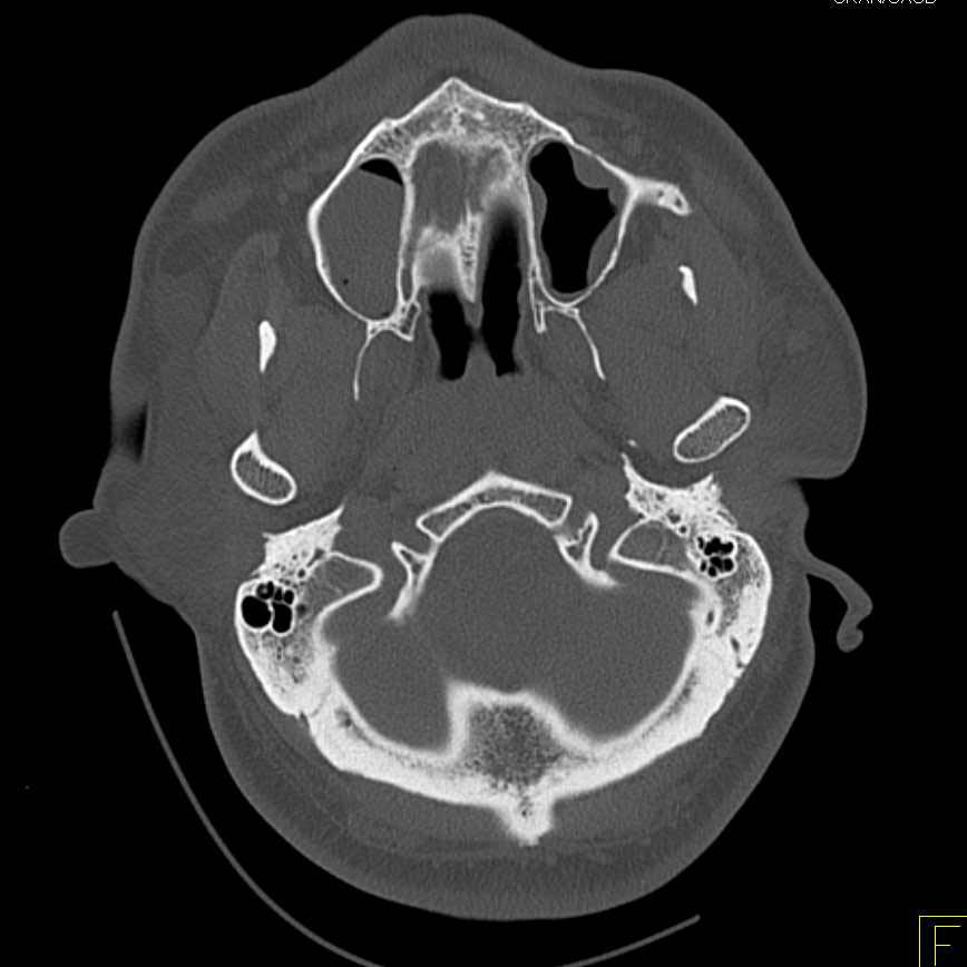 3D of Skull and Spine Post Trauma with Sinusitis - CTisus CT Scan