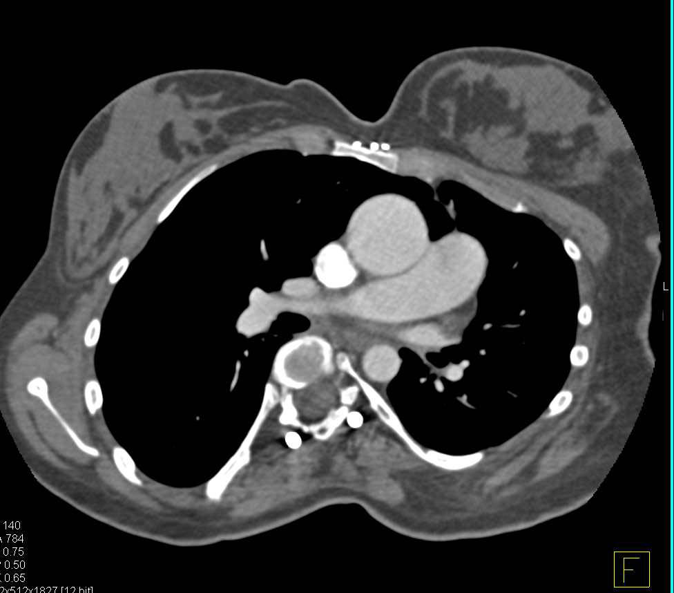 Tortuous Carotid and Vertebral Arteries in a Loeys-Dietz Patient - CTisus CT Scan