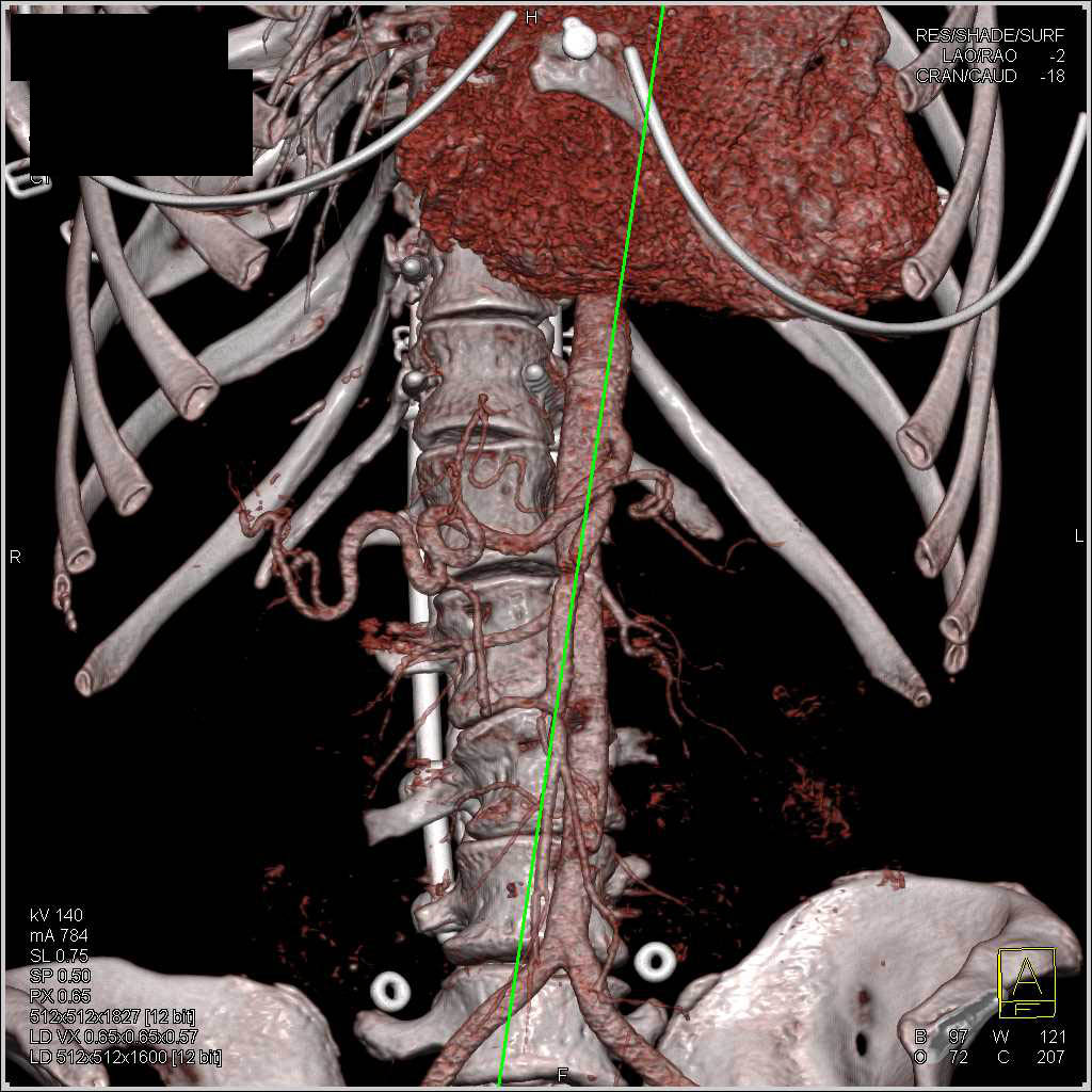 Tortuous Carotid and Vertebral Arteries in a LoeysDietz