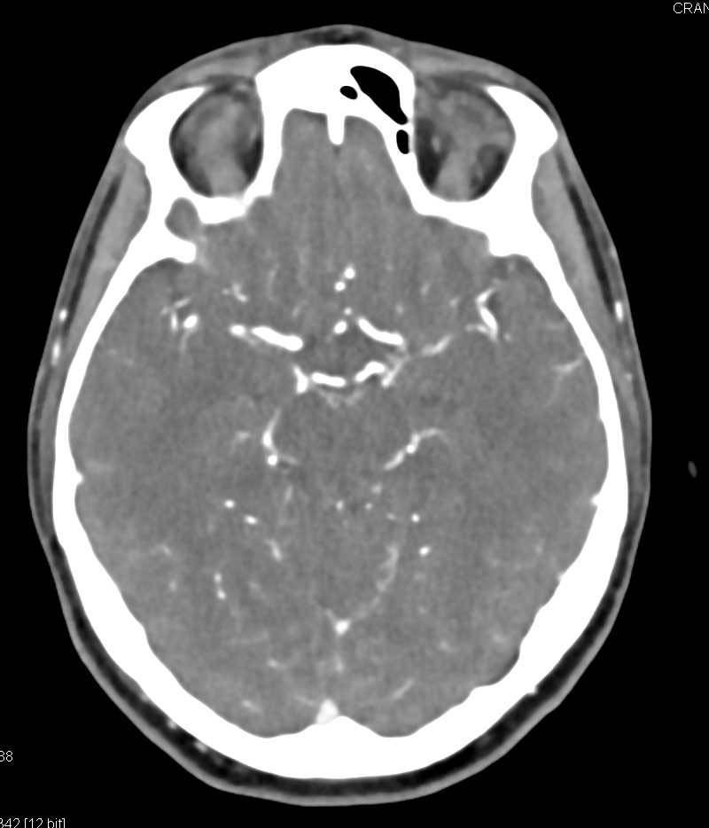 CTA Circle of Willis - Neuro Case Studies - CTisus CT Scanning