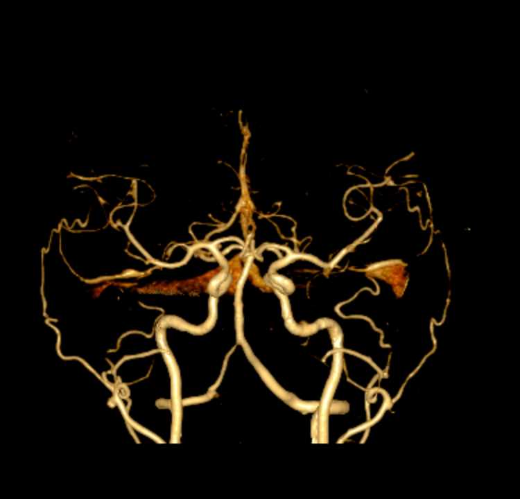 CTA Circle of Willis - CTisus CT Scan