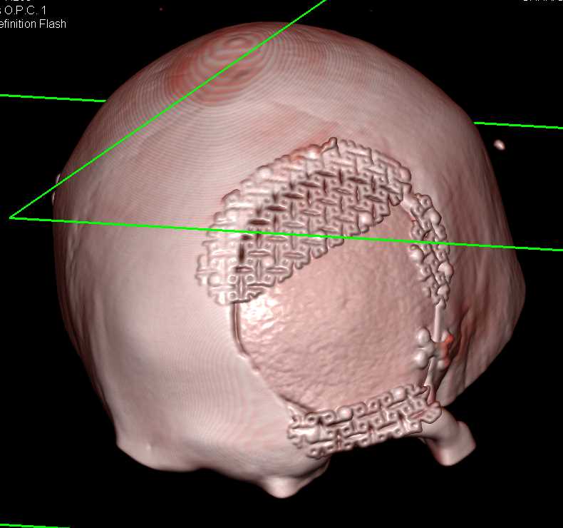 3D of Cranial Surgery - CTisus CT Scan