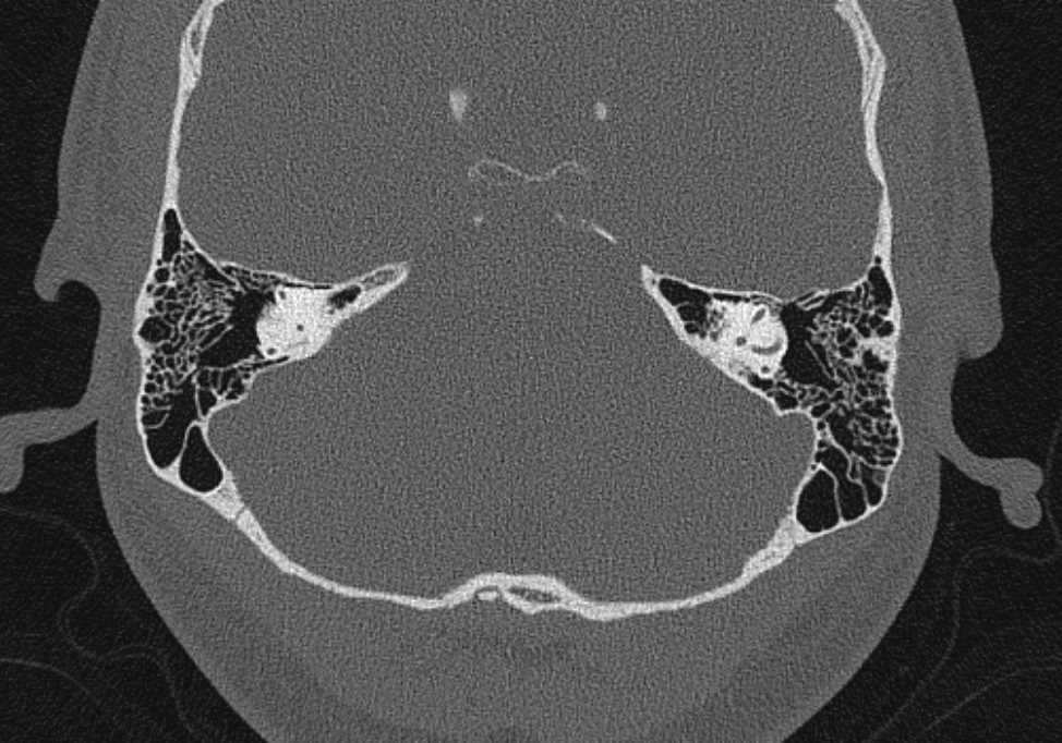 CT of the Inner Neuro Case Studies - CTisus CT Scanning