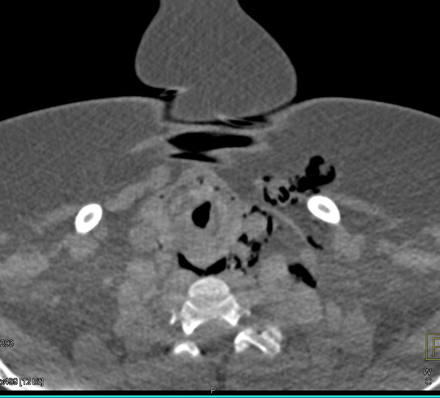 Pneumomediastinum Post Trauma - CTisus CT Scan