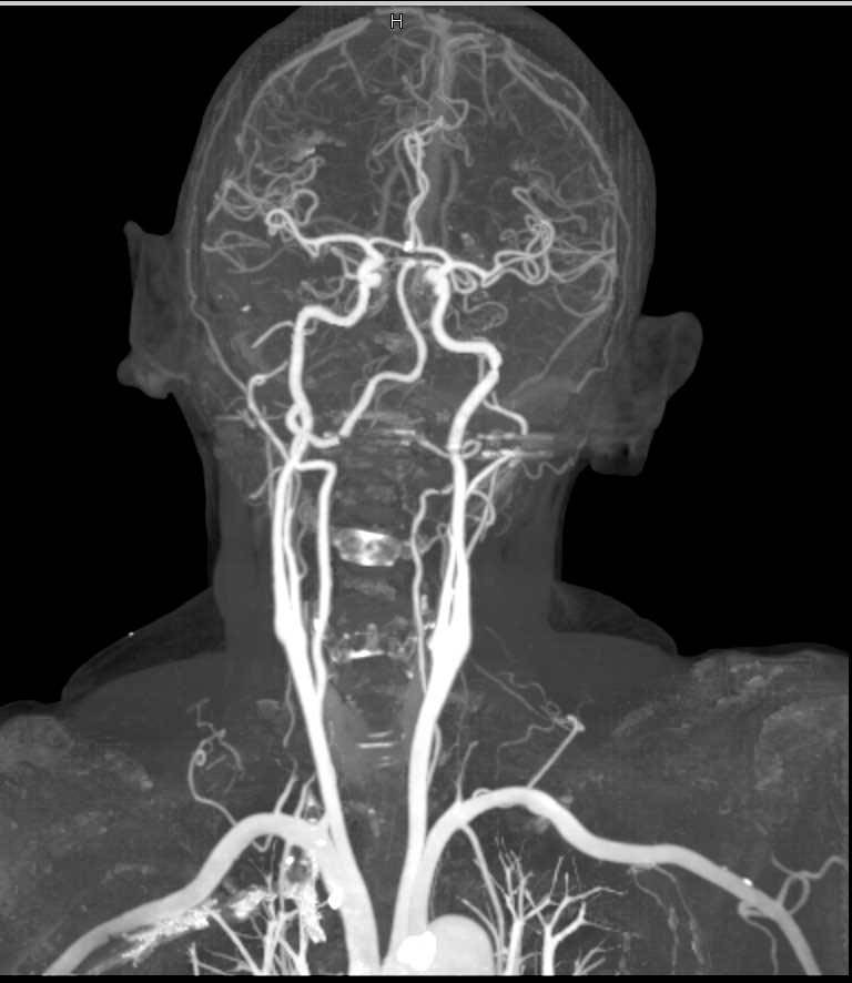 CTA of the Carotid Arteries with Dual Energy - Neuro Case Studies