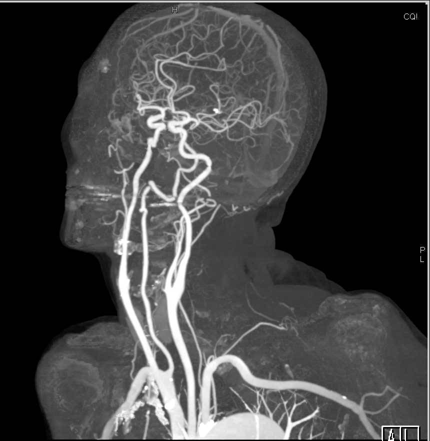 CTA of the Carotid Arteries with Dual Energy - Neuro Case Studies