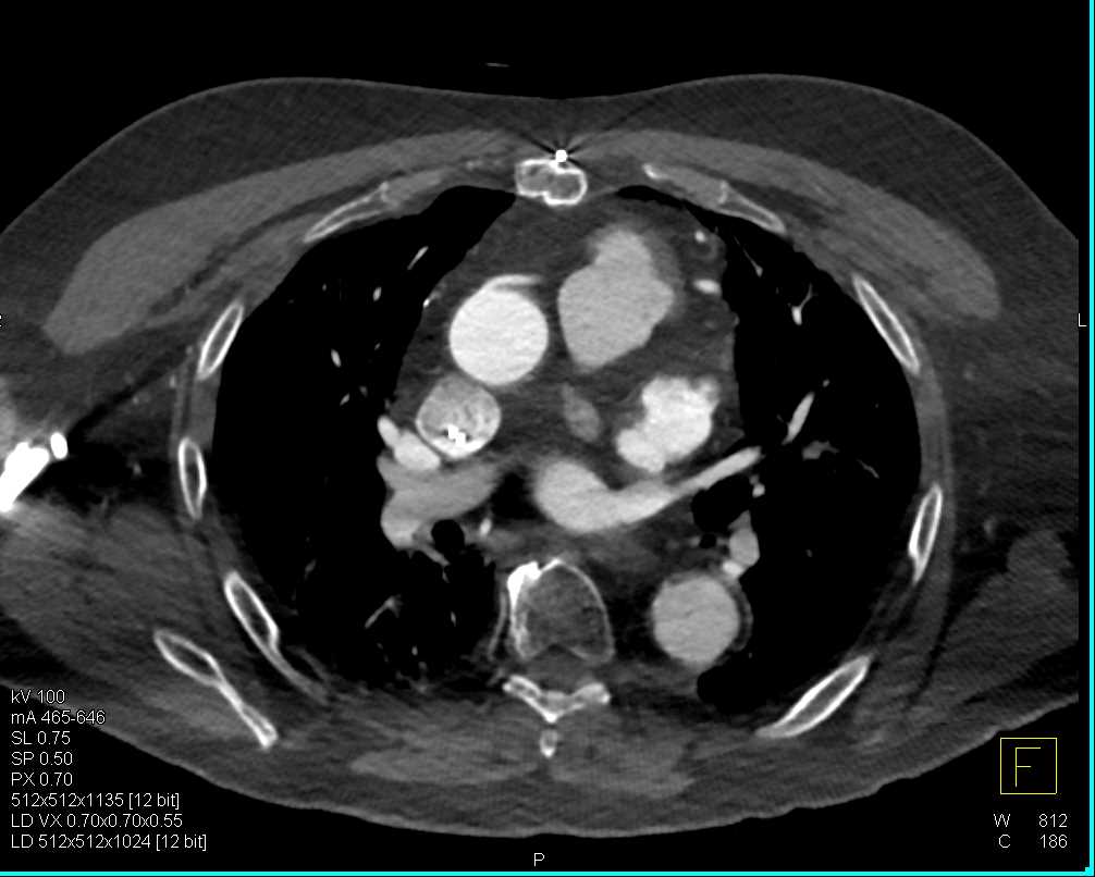 CTA Neck and Arch - CTisus CT Scan