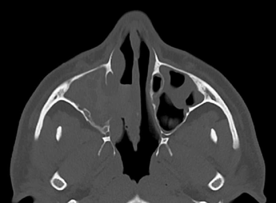 Allergic Fungal Sinusitis - CTisus CT Scan