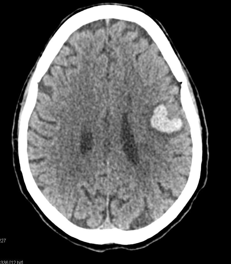 Intra-cranial Bleed - CTisus CT Scan