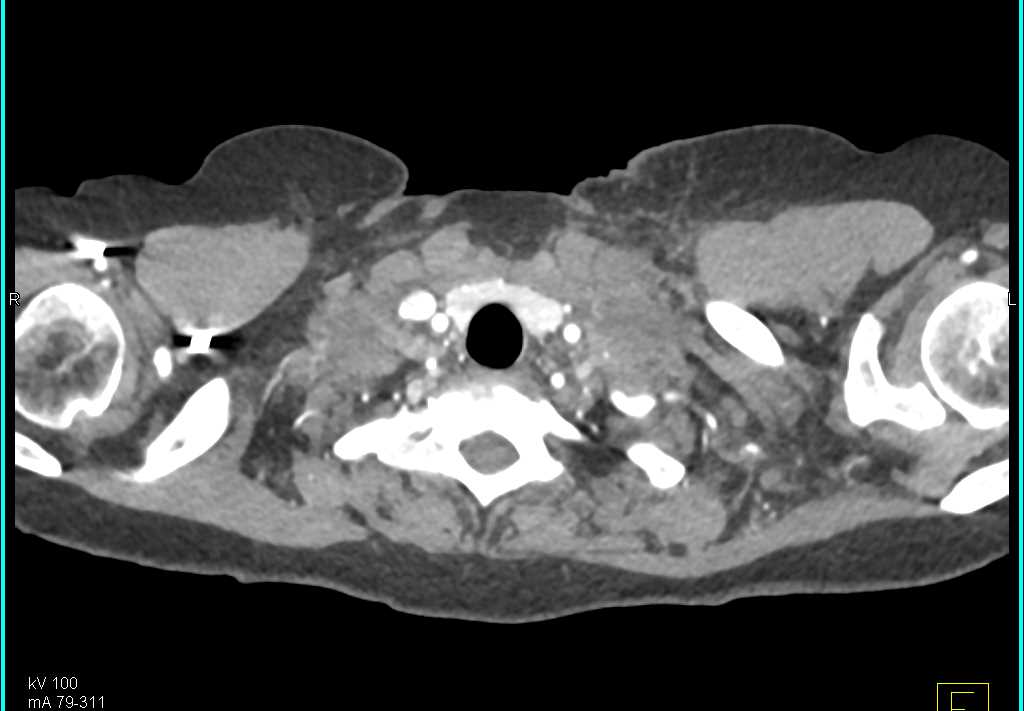 Lymphoma with Impressive Left Supraclavicular Nodes - CTisus CT Scan