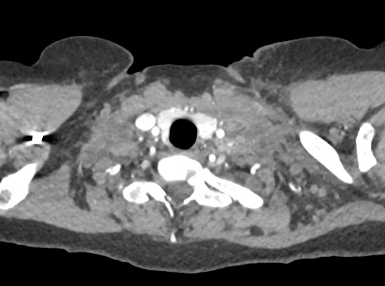 Lymphoma with Impressive Left Supraclavicular Nodes - CTisus CT Scan