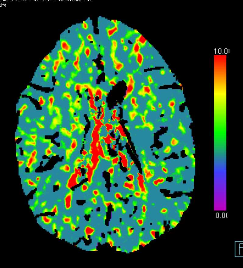 Perfusion Imaging of the Brain for Stroke - Neuro Case Studies - CTisus ...