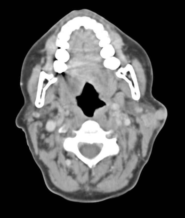 Lymphoma Involves the Left Supraclavicular Zone - CTisus CT Scan