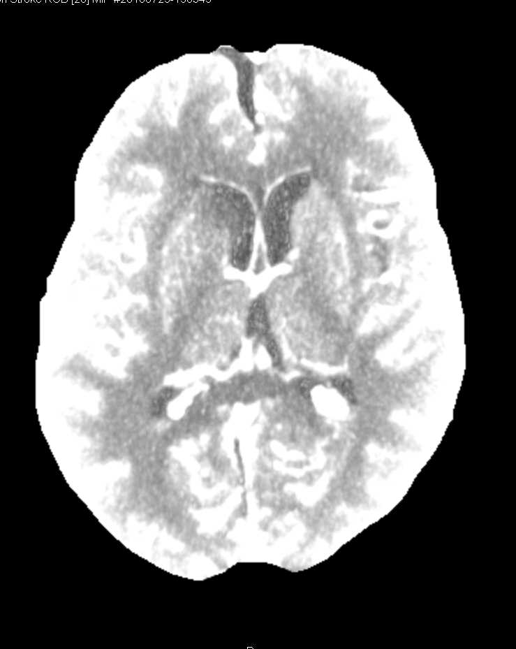 Brain Perfusion Study - CTisus CT Scan