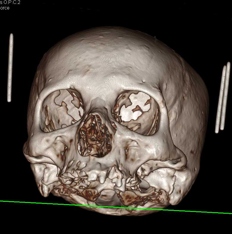 3D of the Skull - CTisus CT Scan