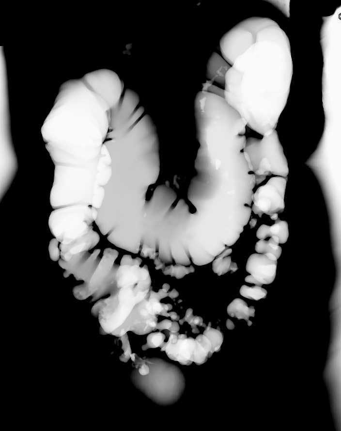 Diverticular Disease - CTisus CT Scan