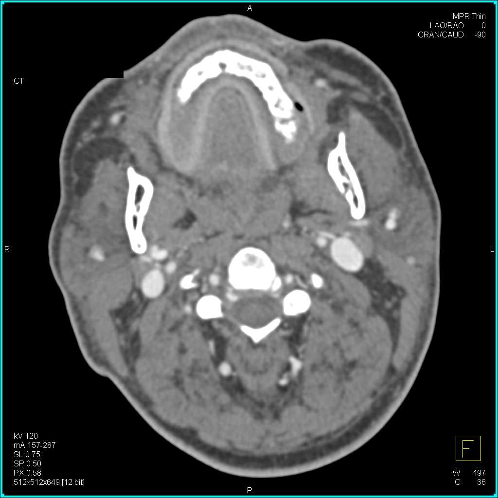 Jugular Vein Thrombosis Bilaterally - CTisus CT Scan