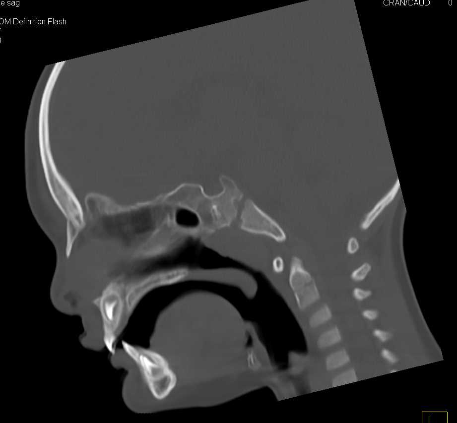 3D CT for Evaluation of the Temporomandibular Joints (TM Joints) - CTisus CT Scan