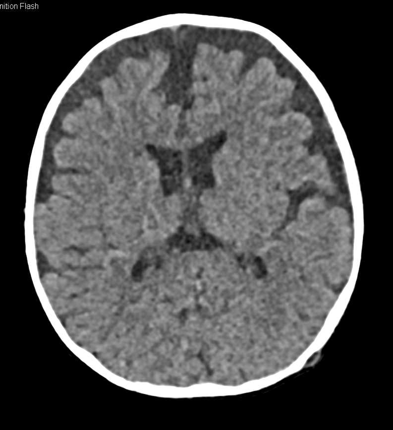 Atrophy of the Brain - CTisus CT Scan