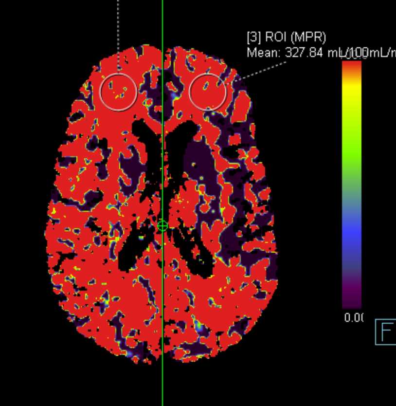 Perfusion CT with Infarction - CTisus CT Scan