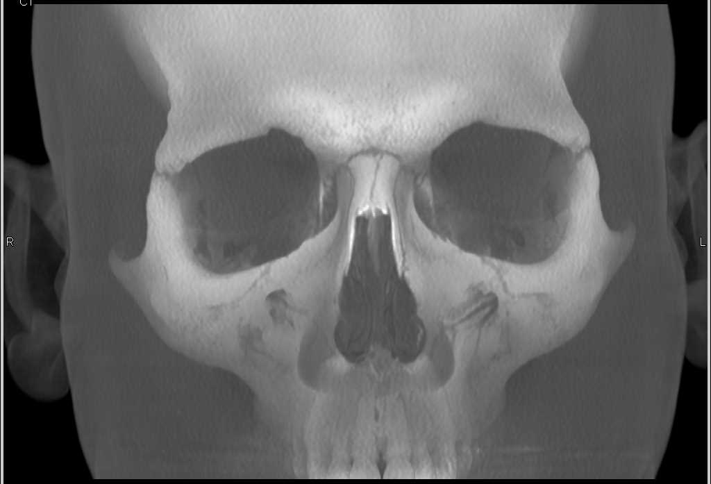 Volume Rendering and Cinematic Rendering of the Facial Bones and Skull - CTisus CT Scan